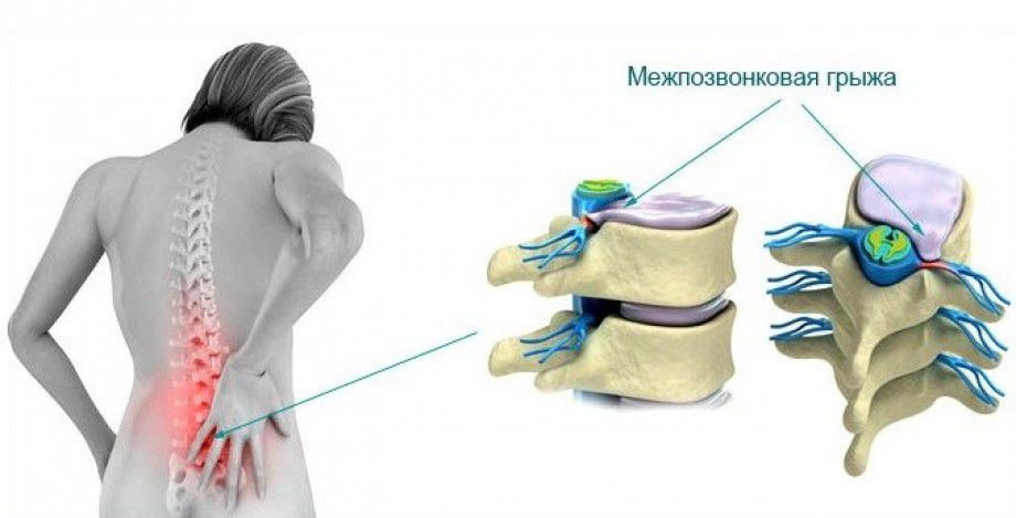 Фото: Медицинское лечение грыжи позвоночника