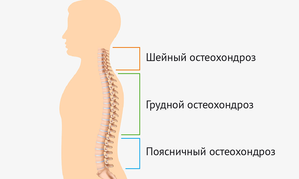 Остеохондроз по-другому называют «старением позвоночника». Это значит, что межпозвоночные диски теряют эластичность, поэтому часто остеохондроз предшествует грыжам