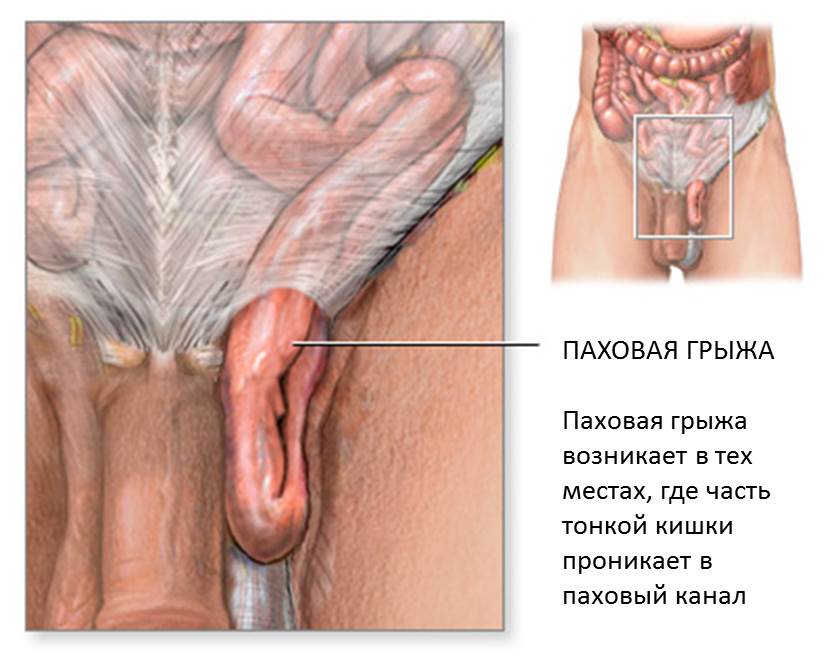 Фото: осложненная мужская паховая грыжа