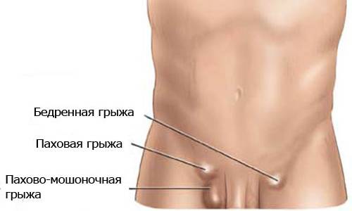 Пахово-мошоночная грыжа у мальчиков - патологическое состояние, характеризующееся выпадением органов брюшной полости в мошонку
