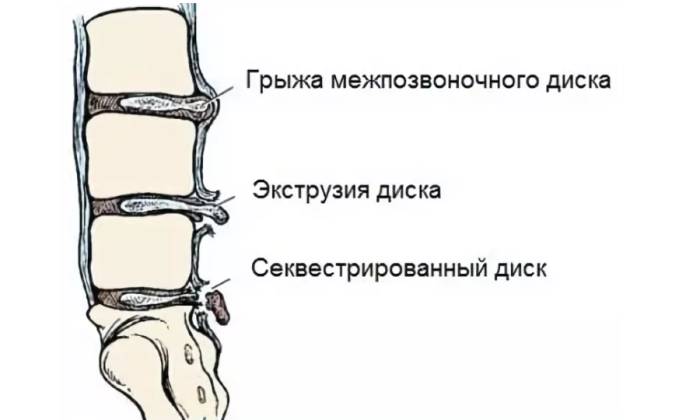 Поводом для операции может стать секвестрированная грыжа - выпадение части ядра диска в спинномозговой канал позвоночника, в этом случае лазер не применяется, нужна классическая хирургия