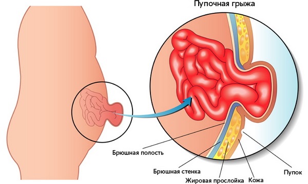 Образовавшийся пупочный грыжевой мешок после родов может стать причиной нарушения пищеварения