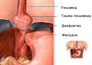 Скользящая грыжа