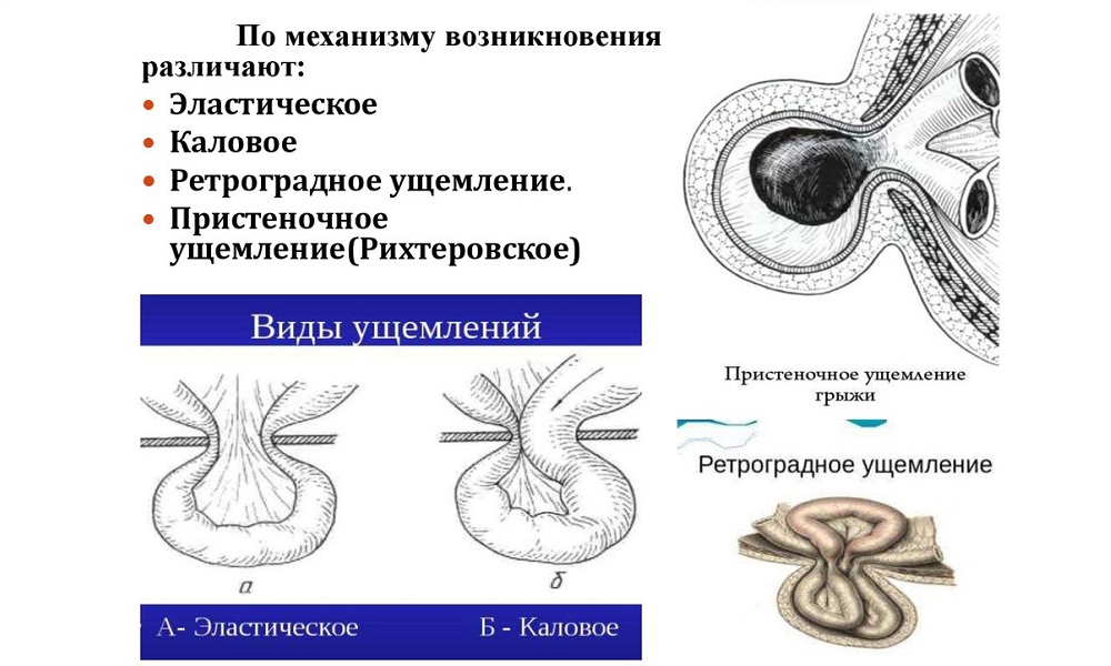 Вторичным ущемлением считается, когда происходит передавливание содержимого уже сформированной грыжи