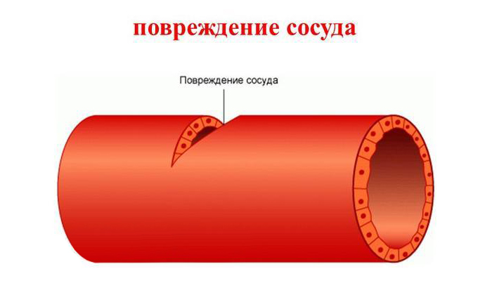 Вторую группу причин повторного образования паховой грыжи составляют ошибки хирурга, такие как повреждение сосудов