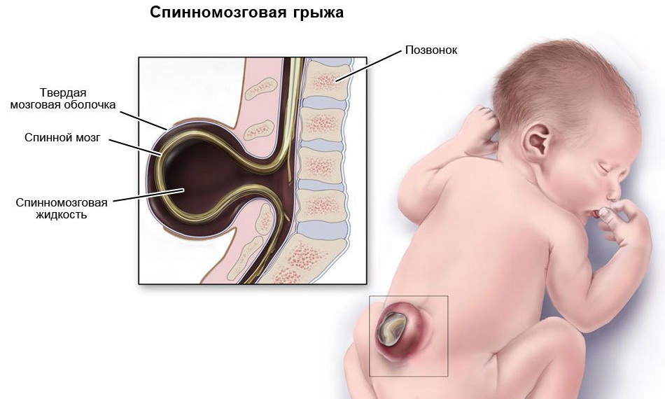 Согласно статистике, примерно в 2/3 случаев дети, рожденные со спинномозговой грыжей, остаются инвалидами на всю жизнь