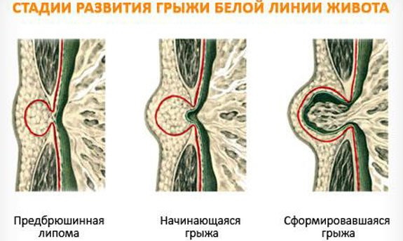Брюшная стенка многослойная и состоит из соединительных тканей, жировой предбрюшинной клетчатки, мышц, скрепляющихся сухожилиями по вертикальной середине живота. Если брюшина слабая, мышцы расходятся