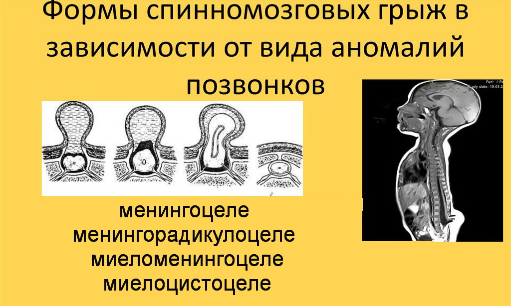 В зависимости от структуры и содержания мешка выделяются 4 формы врожденной грыжи